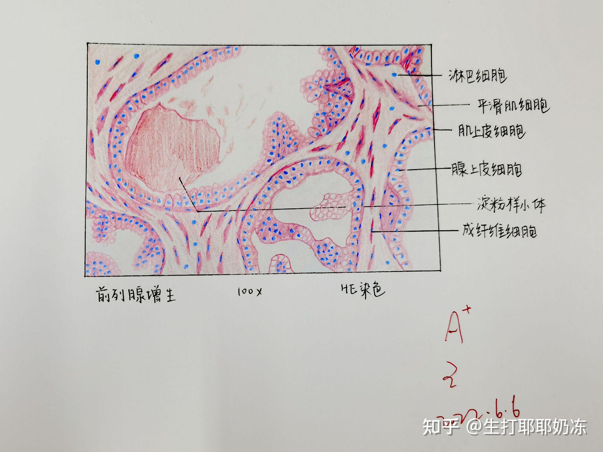 结肠腺癌红蓝绘图图片
