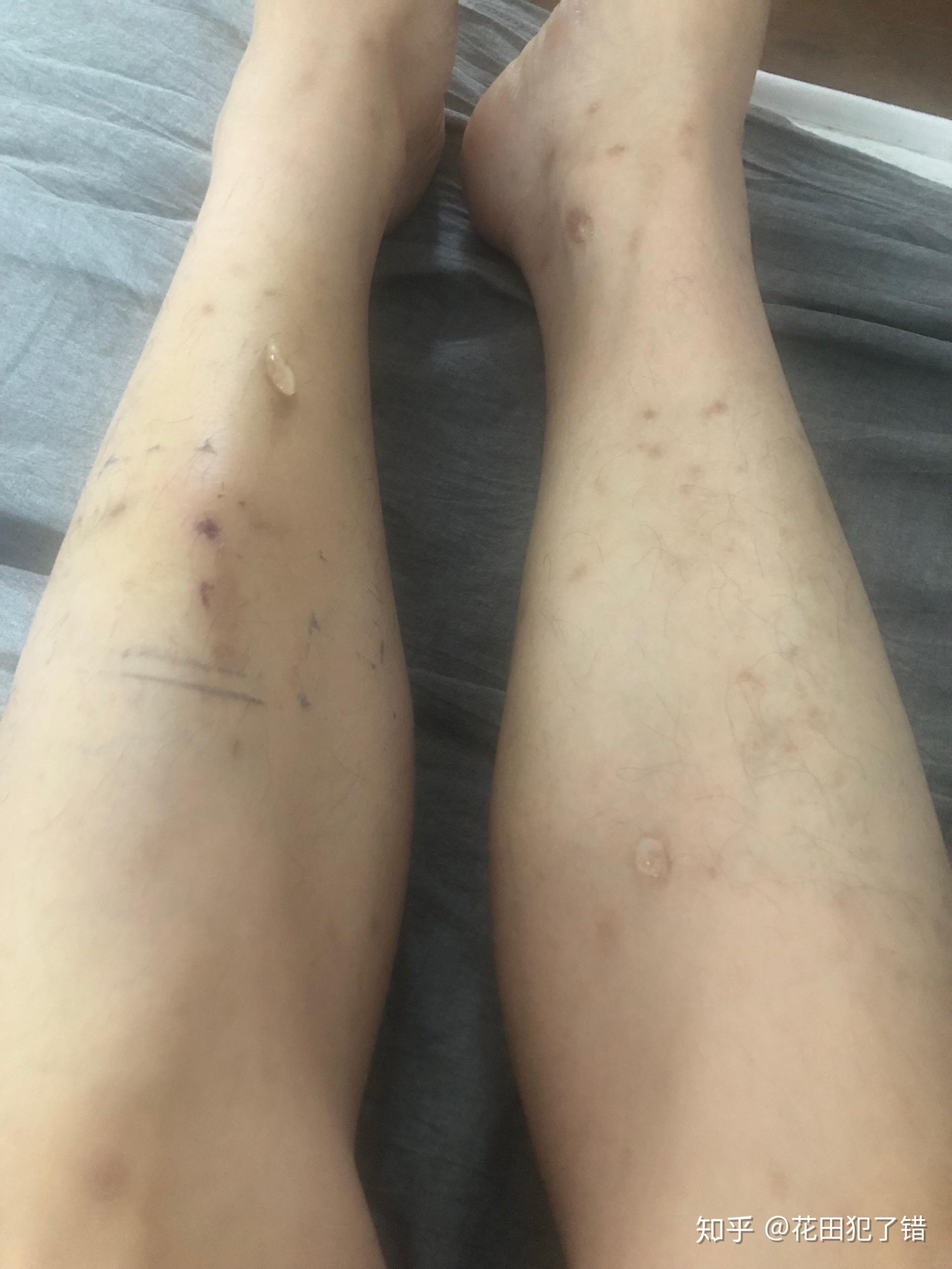 满腿的疤痕怎么消除实测