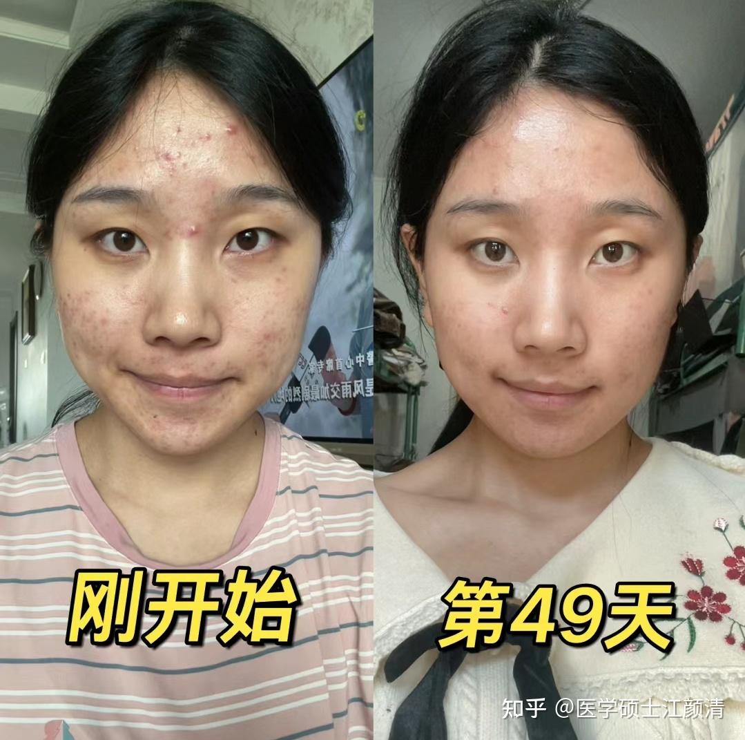 新手小白刷酸篇|医学生教你超详细刷酸保姆级教程,最后3个刷酸步骤80%新手都会忽略,用错=烂脸!