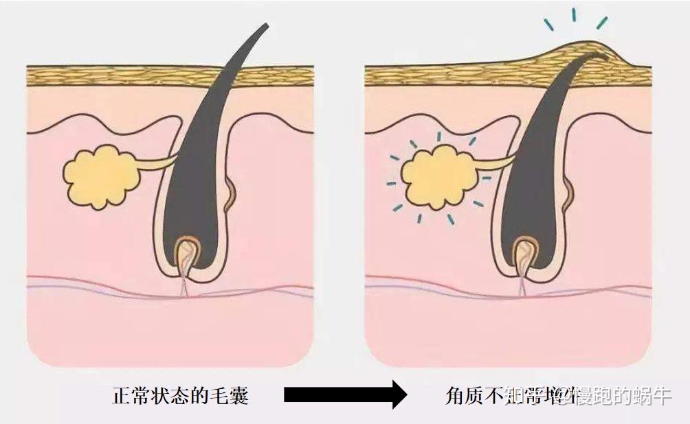 是一种慢性毛囊角化性皮肤病,也被称为毛周角化,毛发苔藓或毛发角化病