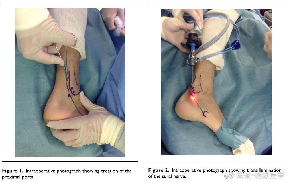 脚踝弹响小心这个脱位