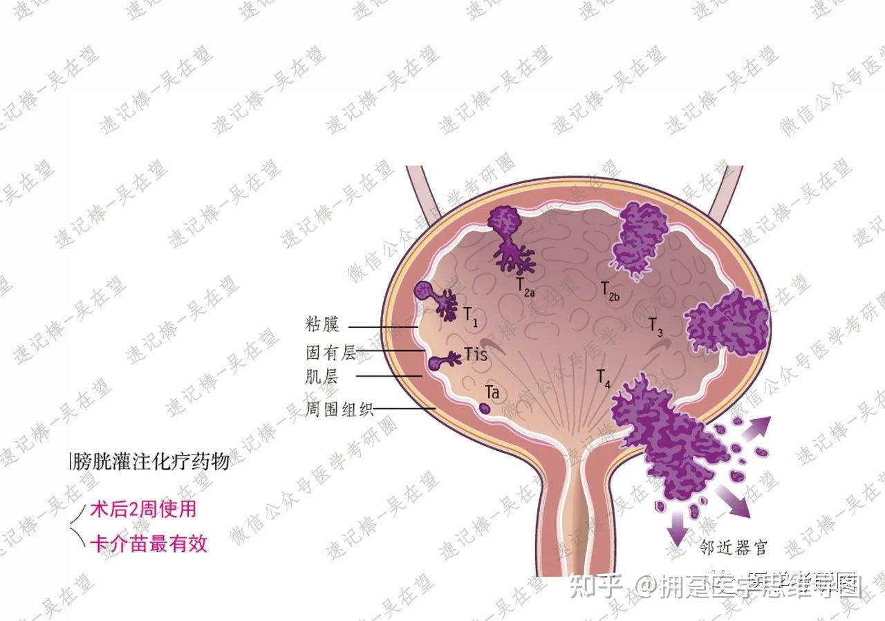 膀胱癌分期治疗泌尿系统思维导图