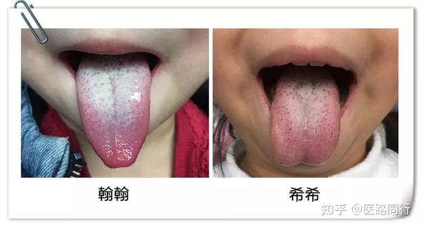 【舌象】草莓点舌象的对比及调理 - 知乎