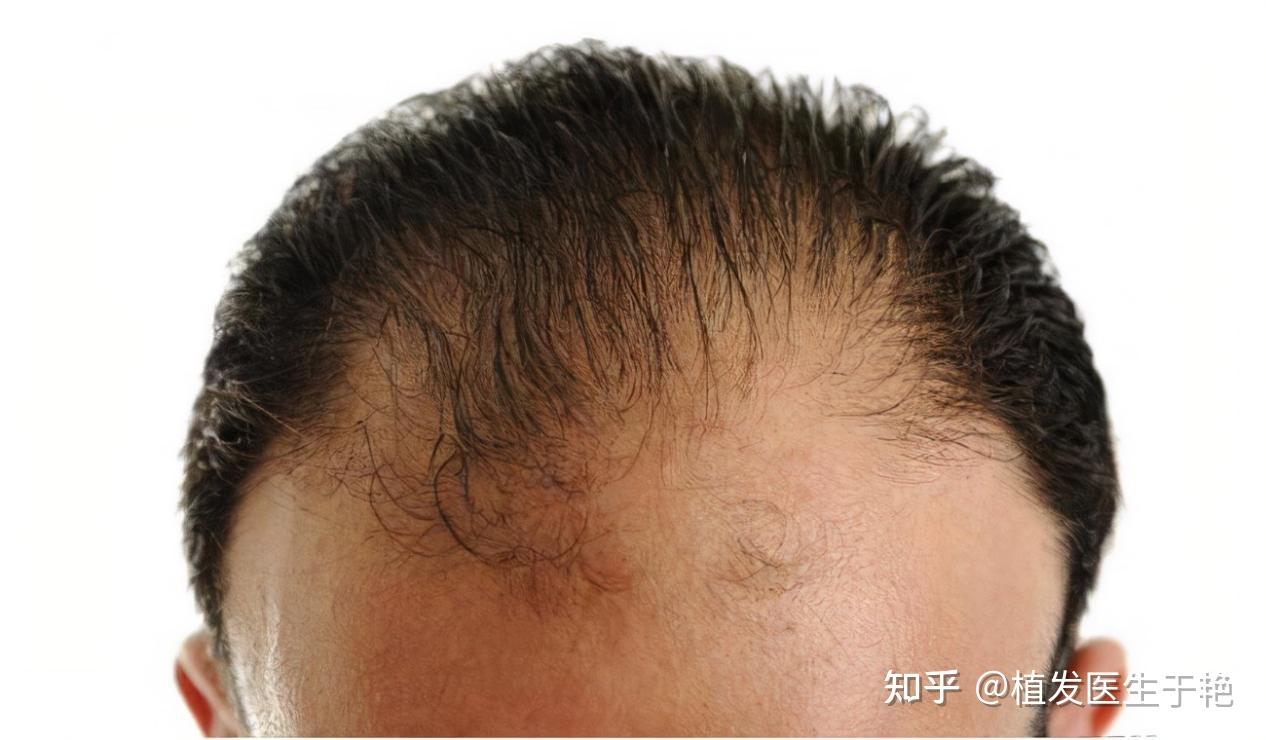 是头发生长的根基,如果坏死就不能长出新的头发了,那么,引起毛囊坏死