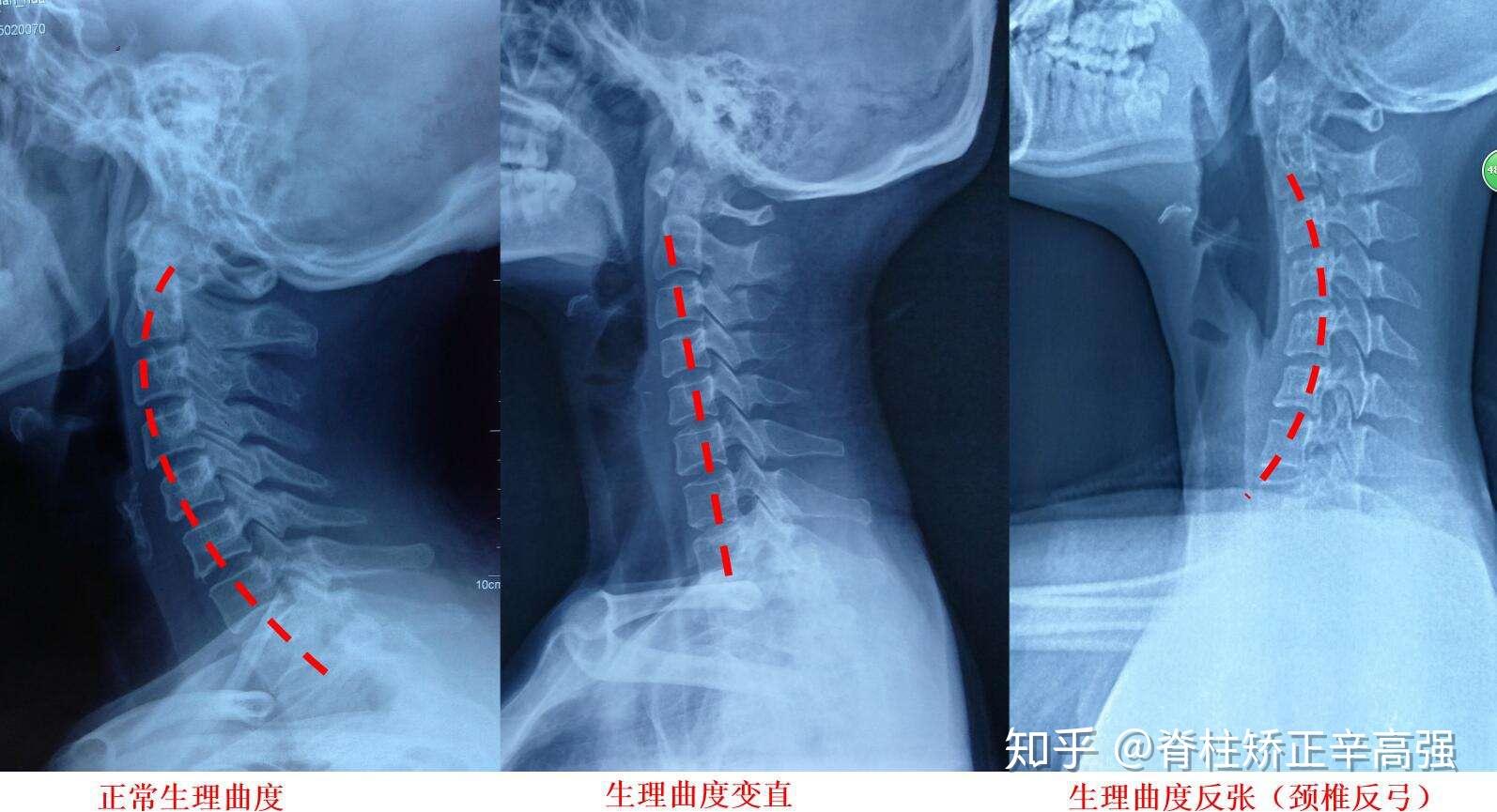 颈椎x线图片,颈椎正常线,肩关节线图片_大山谷图库