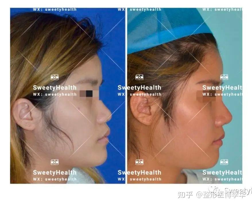SVF脂肪胶填充案例分享 - 知乎
