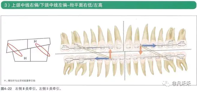 正畸交互牵引示意图图片