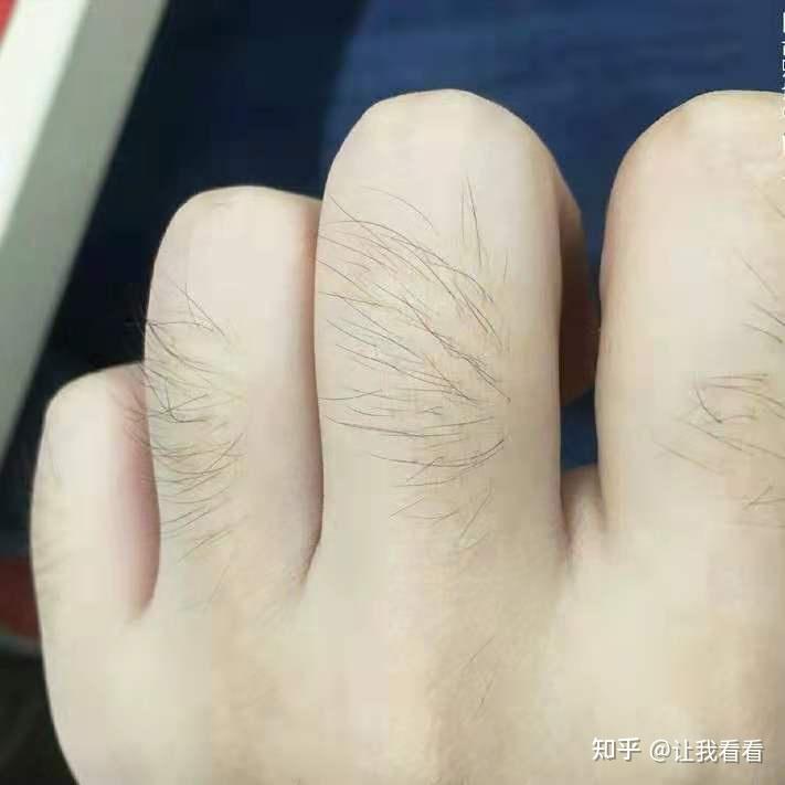 我是女生手背上汗毛很多毛孔特别大密密麻麻的大家有紧毛孔的办法吗