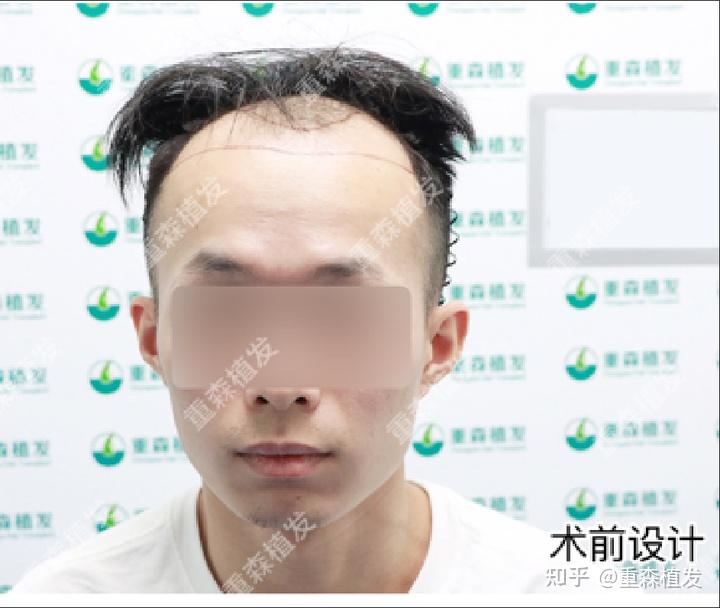 脱发必看！关于植发有多管用？看一下术前术后的对比就知道了！ - 知乎