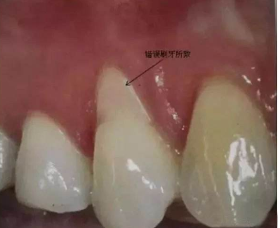 牙龈萎缩了才知道,原来是我一直不会刷牙…后悔莫及了! - 知乎