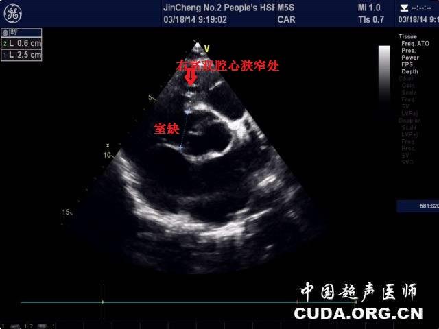 右心室调节束超声图像图片