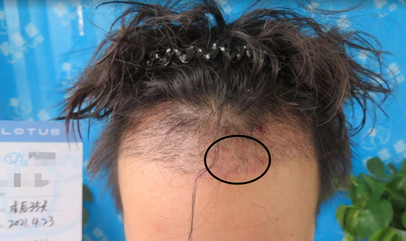 植发后为什么头皮会痒呢(植发后头皮奇痒无比怎么缓解)