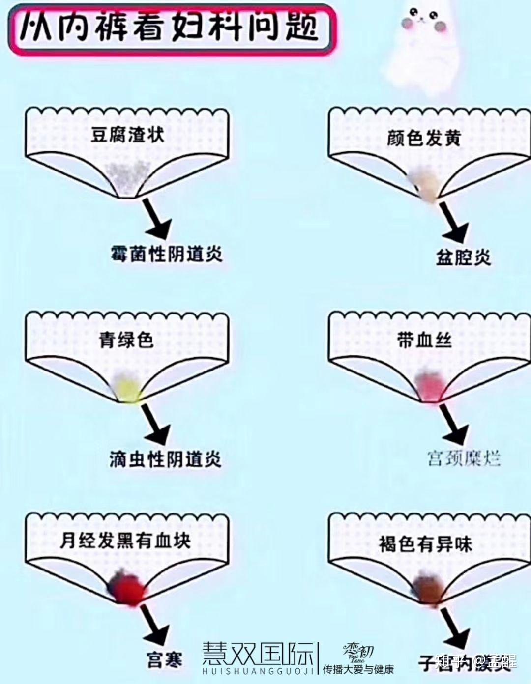 3,内裤黄色白带预示滴虫感染.