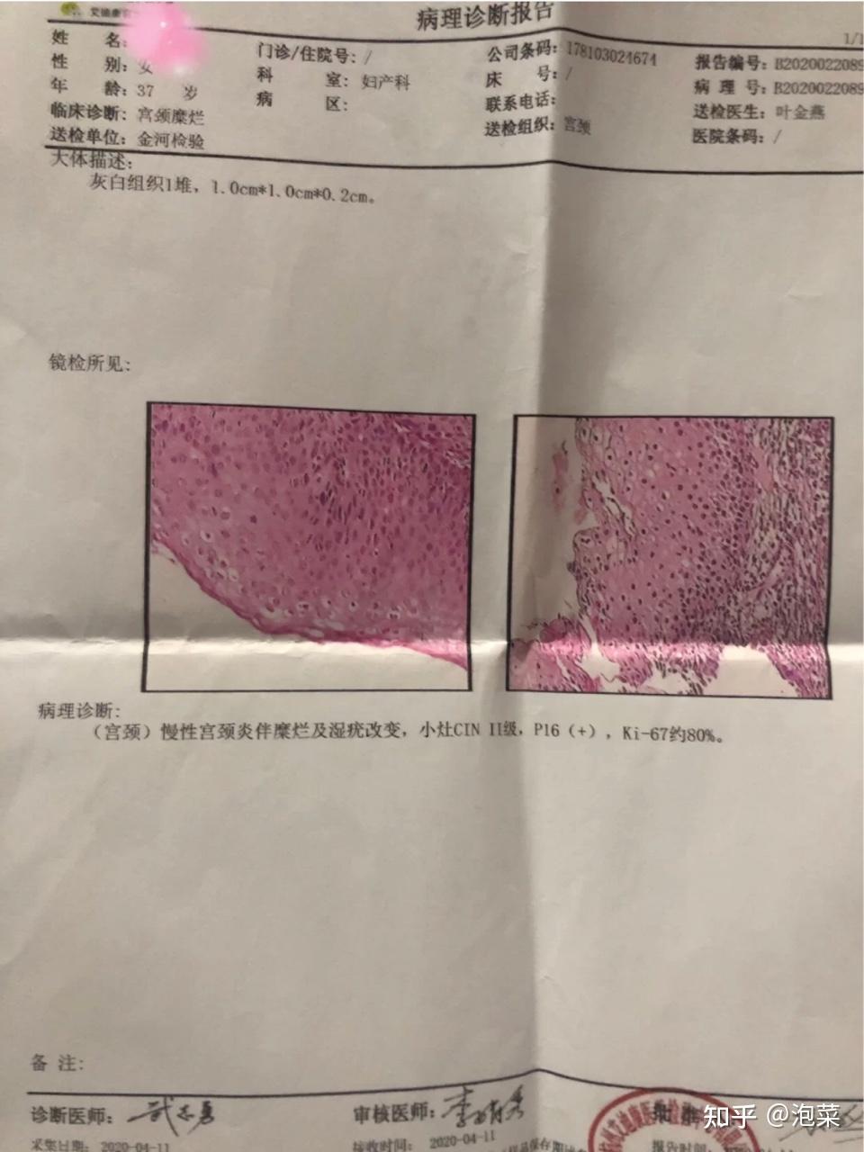 感染hpv不要慌穩住我們能贏