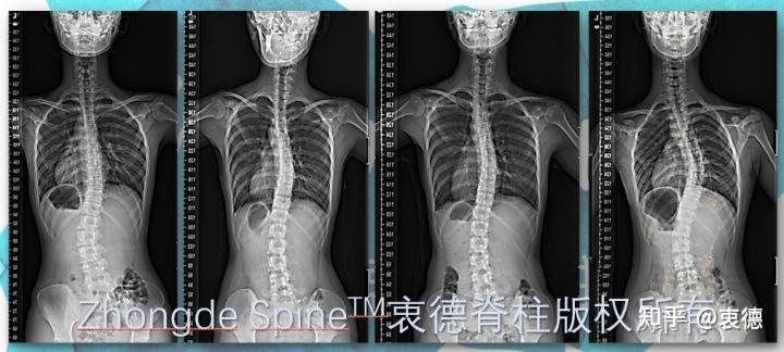 青少年特发性脊柱侧弯发病的原因 - 知乎