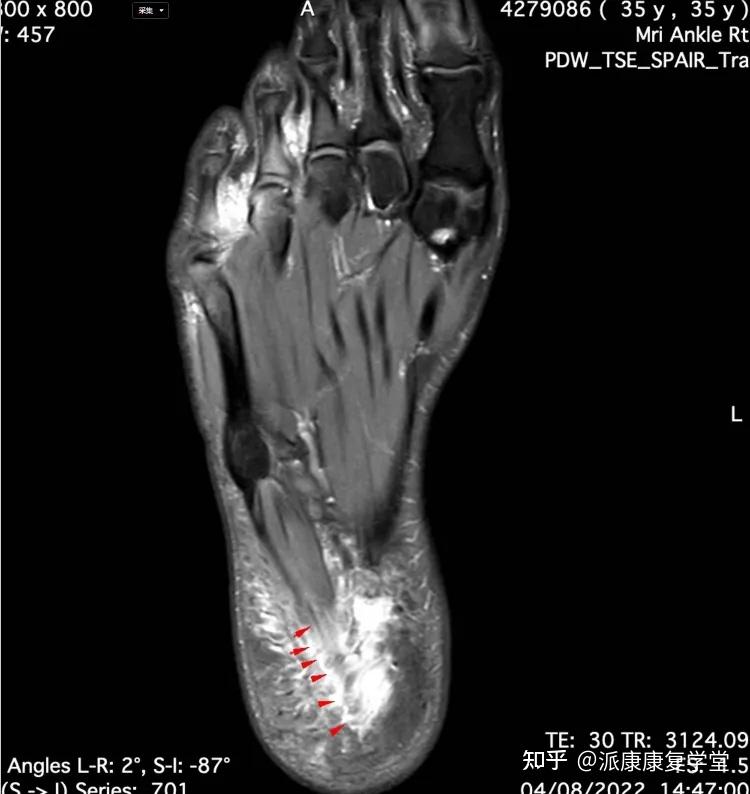足底筋膜断裂图片