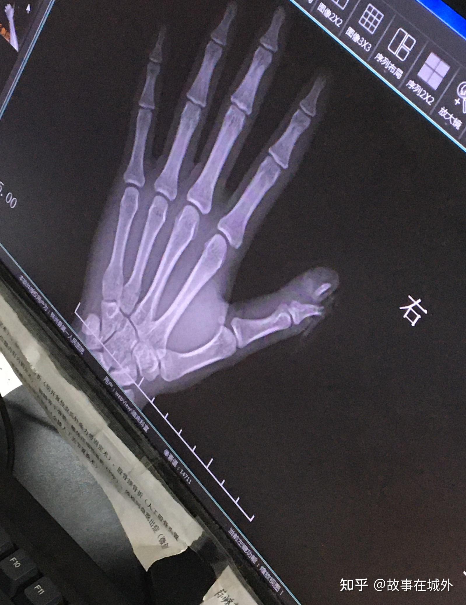 大拇指远节开放性骨折能评伤残吗