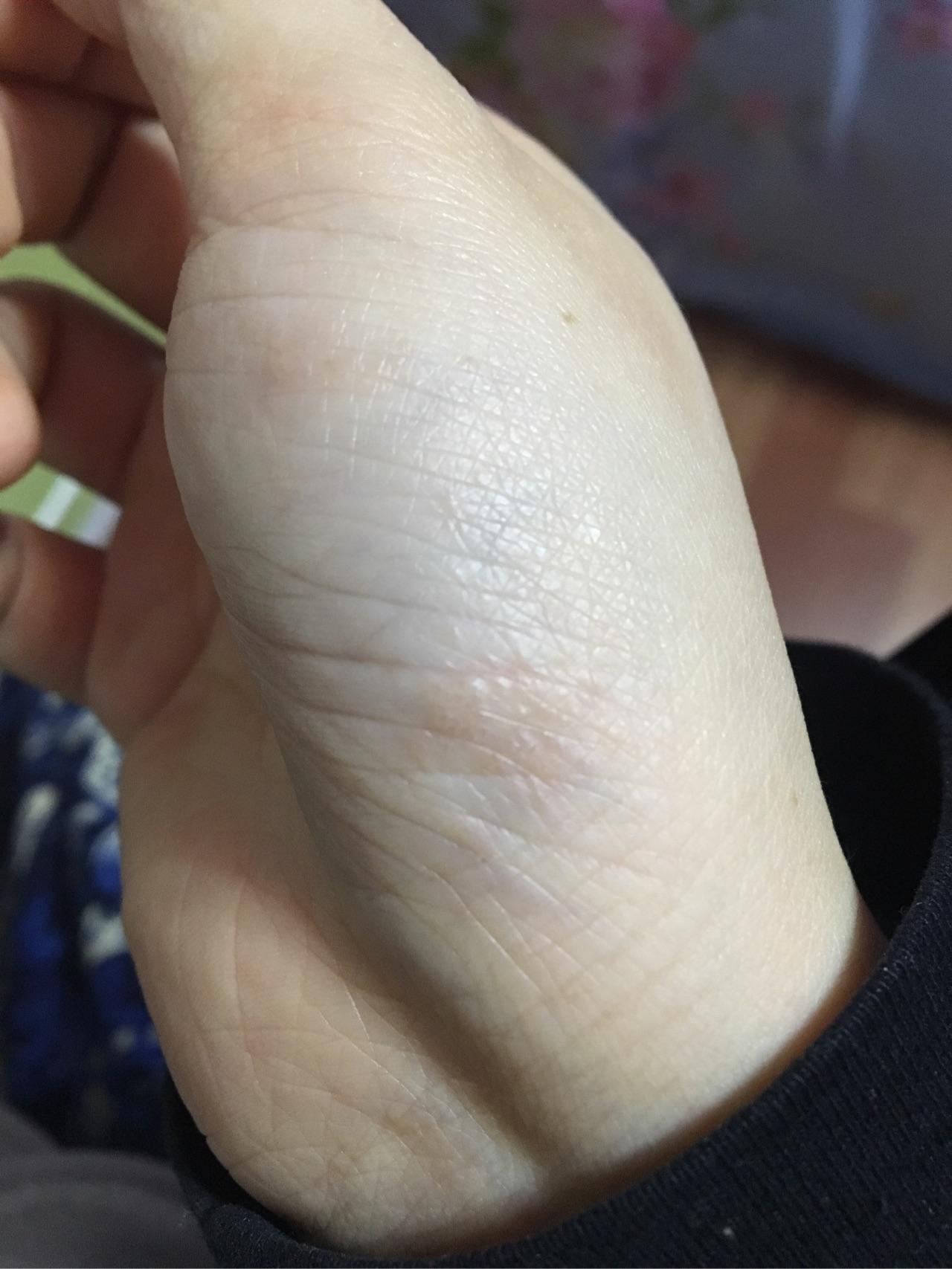 这到底是汗疱疹还是手癣