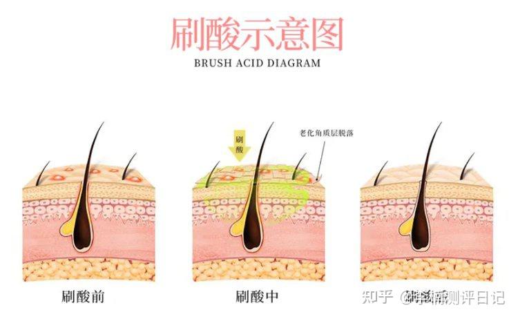 有刷酸需求的进丨【专业配方师】手把手教你科学刷酸全过程!掌握刷酸原理,痤疮/黑头/粉刺全部拜拜!