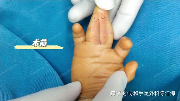 并指免植皮 | 案例14《“菱形”并指分开之后,小手力量很不错》 - 知乎
