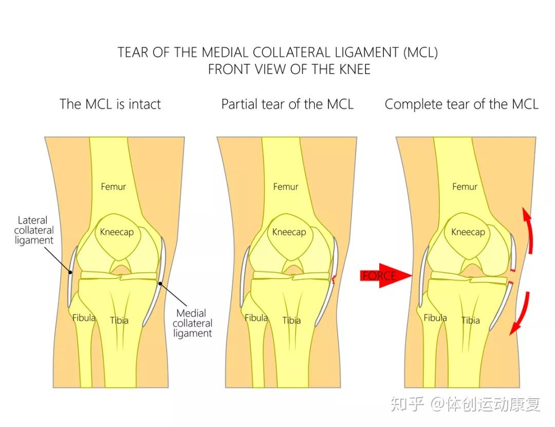 膝盖疼内侧副韧带伤了该如何康复