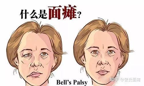 面瘫早期症状会引起面部肌肉表情僵硬,以及口角歪斜等症状,而且还有