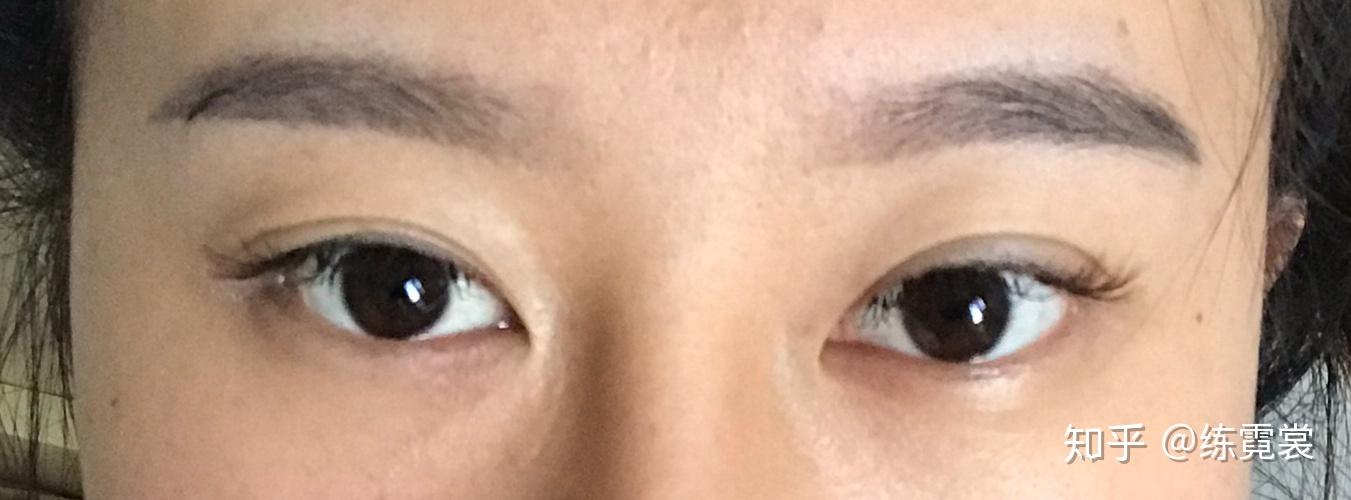 双眼皮修复手术一个月了眼头分叉能恢复吗还是失败了需要再修复