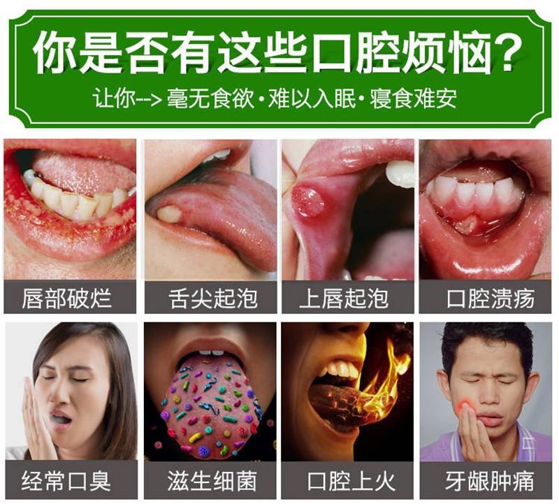 口腔溃疡 口腔溃疡