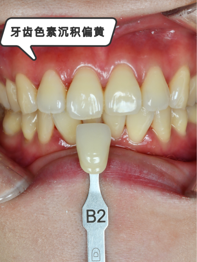 牙齿不是越白越好,最健康的牙齿,应该呈现出其本来的颜色:乳白/淡黄