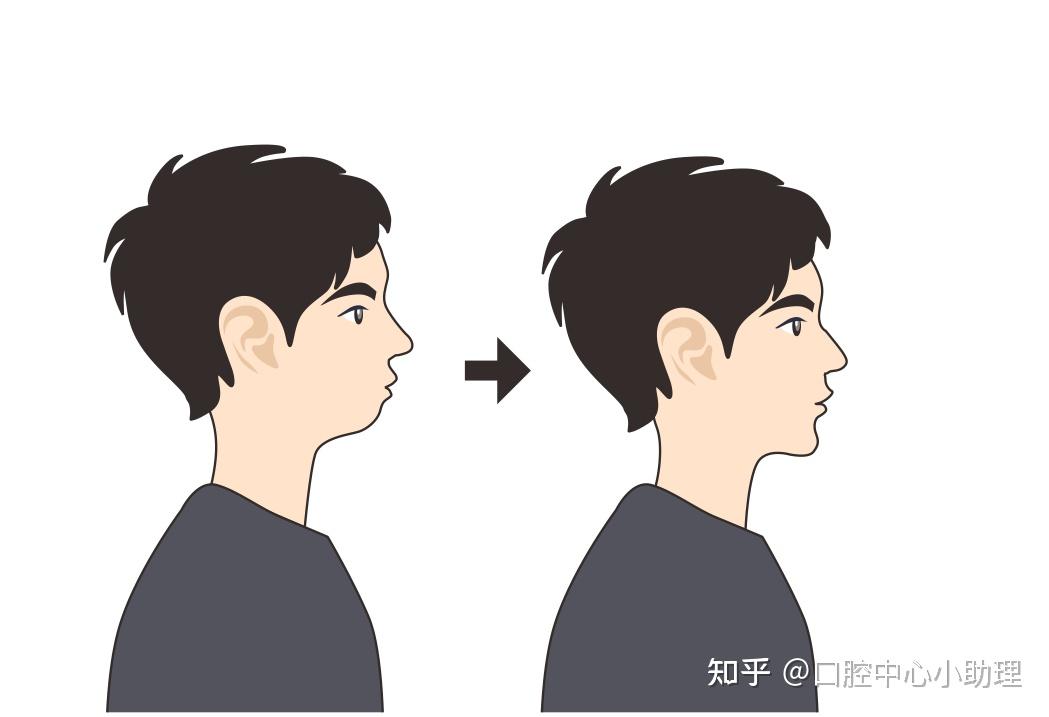 嘴角下垂总是“难过脸”,整牙能改变吗? - 知乎