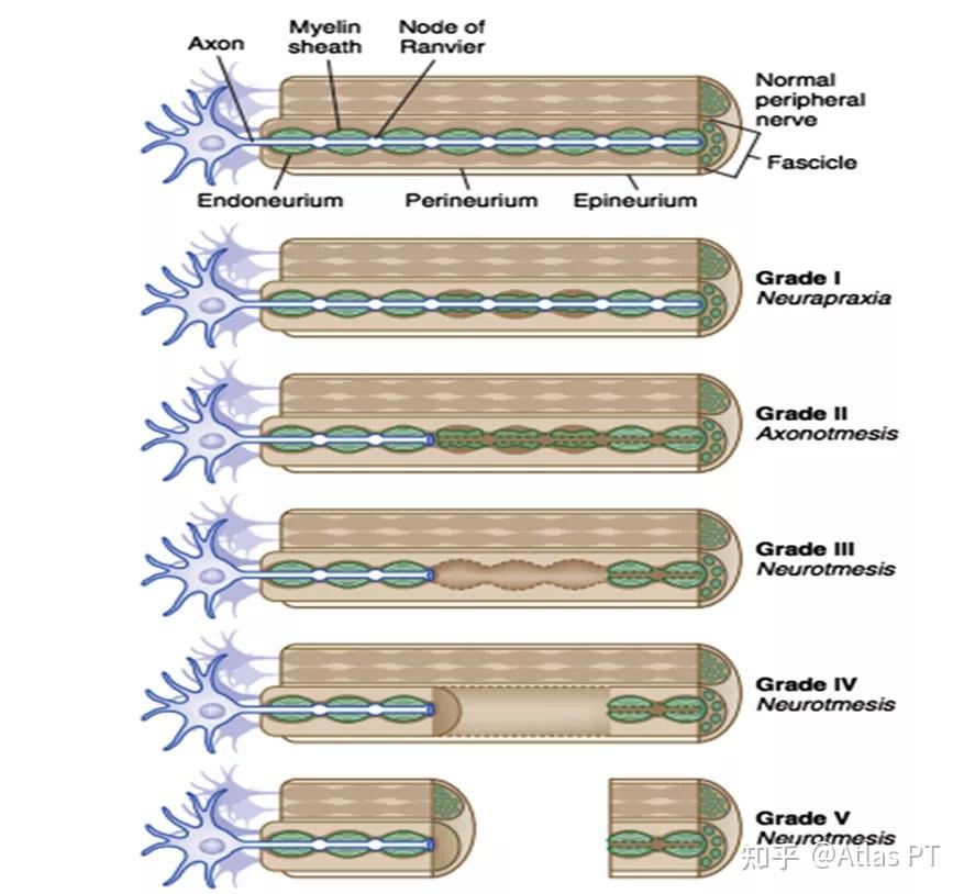 你了解神经损伤分类吗