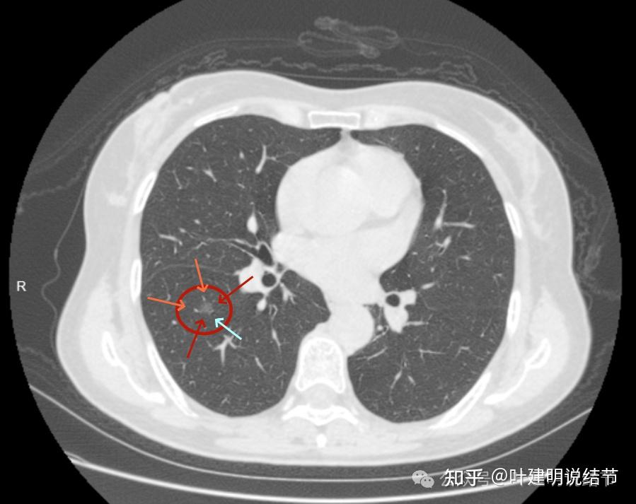 无法想像肺多原发早期肺癌没有治疗的标准答案