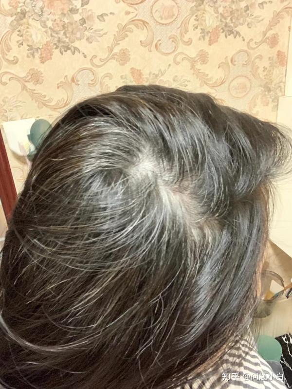 听说白发不可逆,难道我这种因为压力才长的白发真的没救了吗? - 知乎