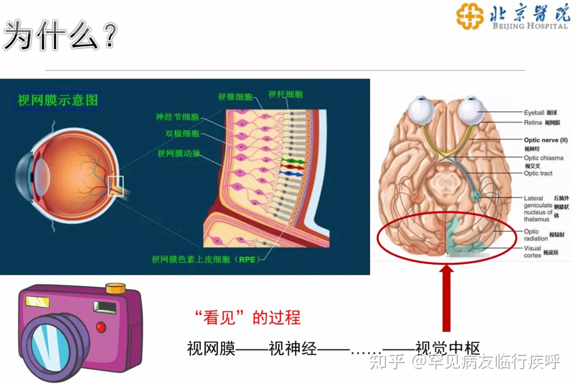 視神經炎中的神經損傷 脫髓鞘 神經軸索損傷 視覺障礙為何無視神經炎