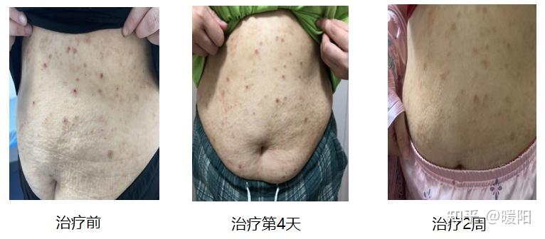 特应性皮炎||温情携手jak1,陈岚教授谈"小分子"治疗ad"痒醒症"