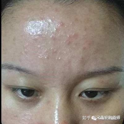 了解油性敏感肌肤，护理不再是难事！|宋晶 - 知乎