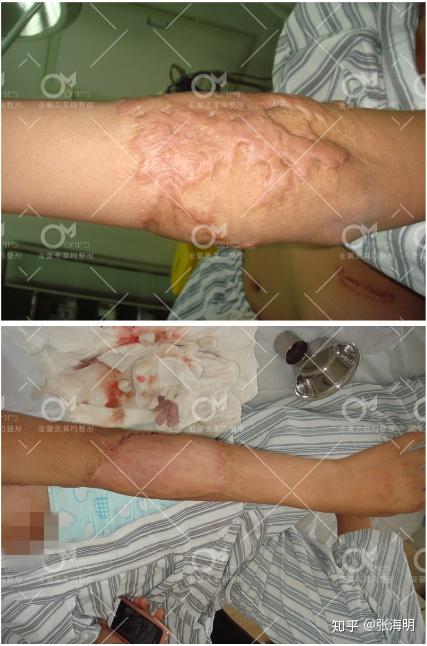 扩张器治疗疤痕图片