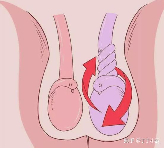 阴囊松弛睾丸下垂巨型图片