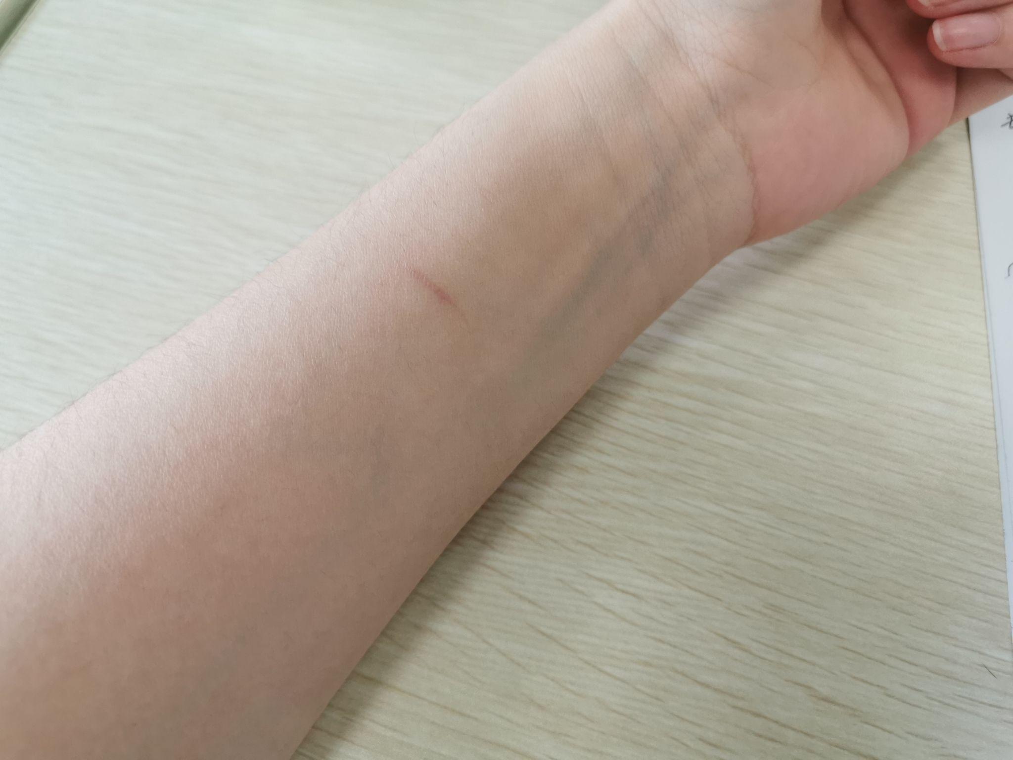 对于一个割腕过的人未来如何向别人解释这道疤的由来