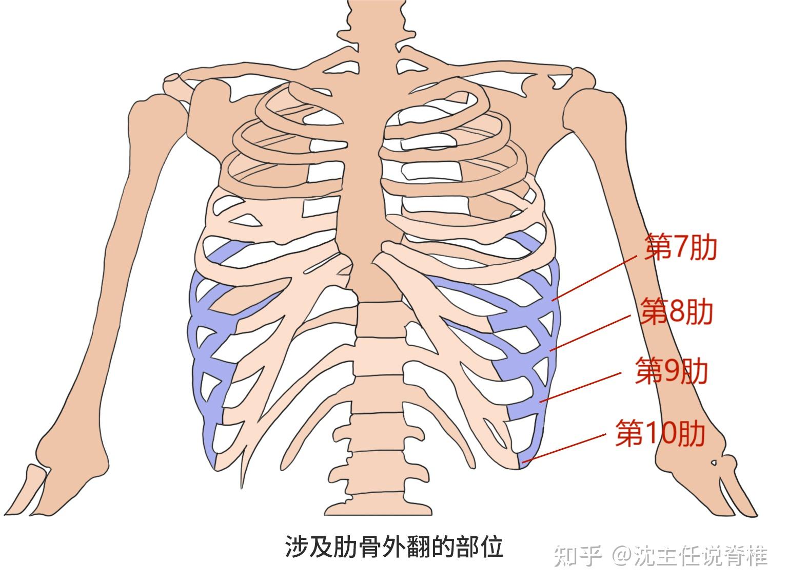 肋骨外翻