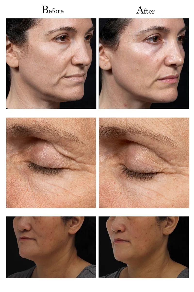 漂亮主义丨半岛超声炮——立即性收缩紧实效果,长期性紧致轮廓提拉