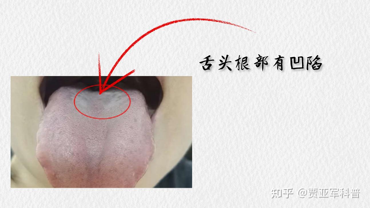 气虚怎么补?舌象告诉你答案,医生教你如何正确调理五脏气虚 - 知乎