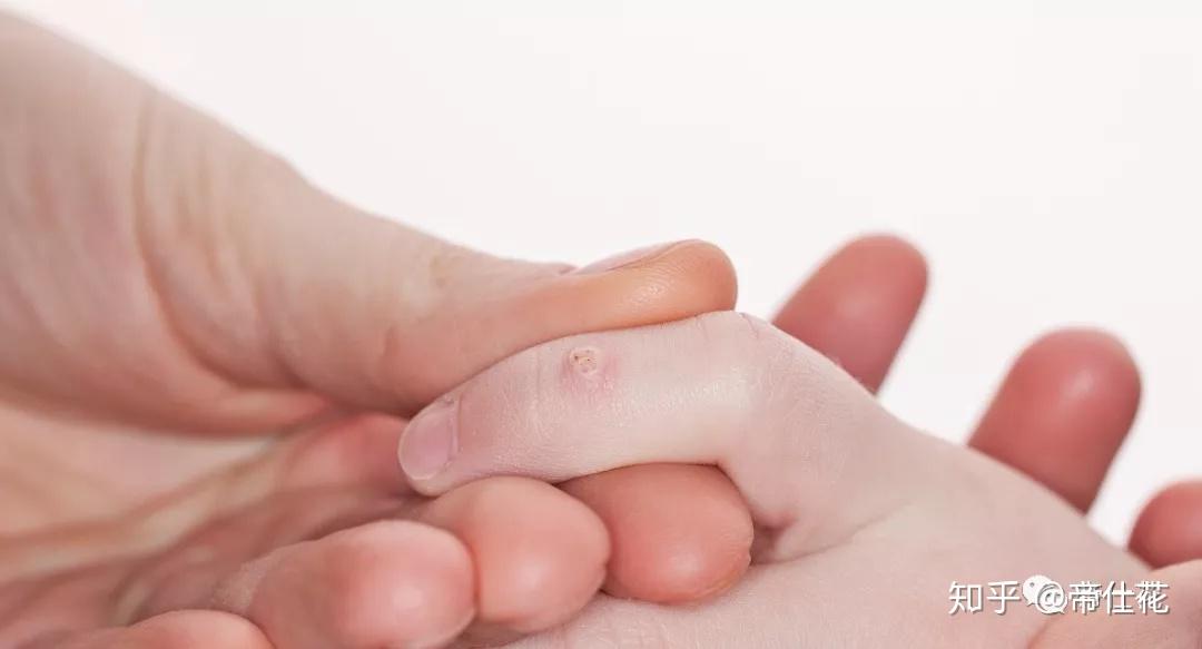 很多人会用很多民间方法,什么螳螂咬,无花果汁抹,大蒜擦拭等等一些法