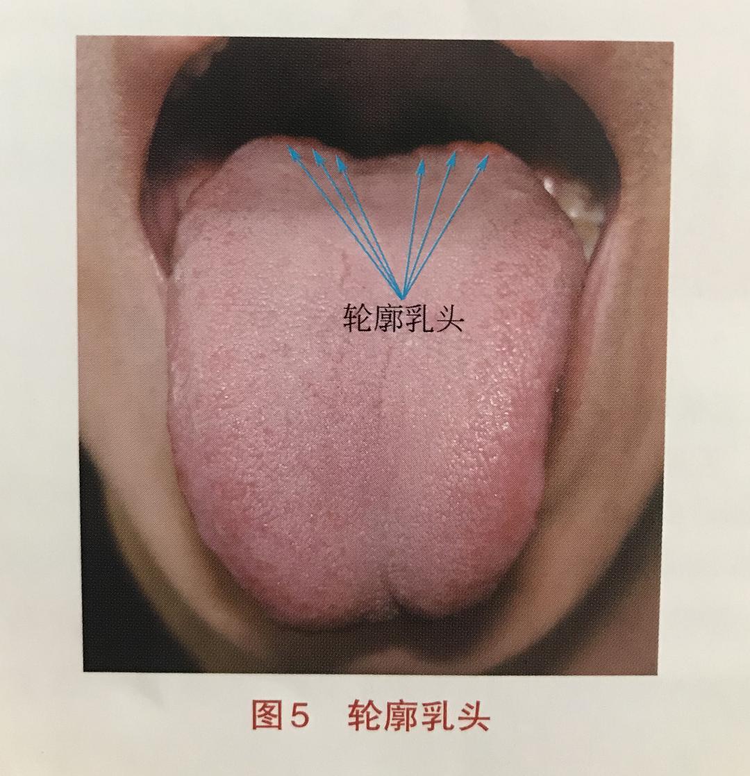 轮廓舌乳头炎图片