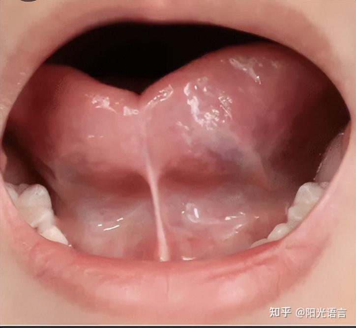 舌系带剪还是不剪?0-4岁分两步看,避免孩子说话不清楚