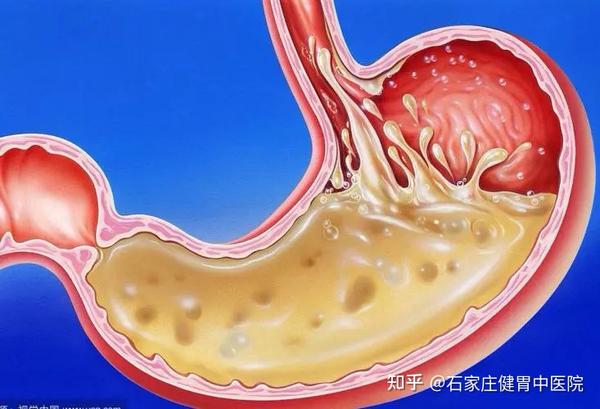 胃反酸，往上反酸水是怎么回事？ - 知乎
