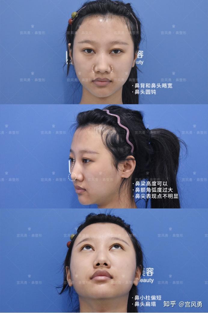 术前的主要问题是因为鼻背宽导致整个面部看起来不够精致,鼻梁高度
