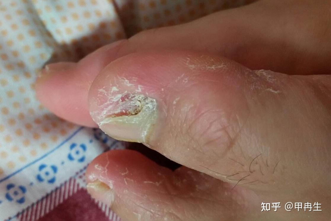 灰指甲别不在意,真菌危害太大