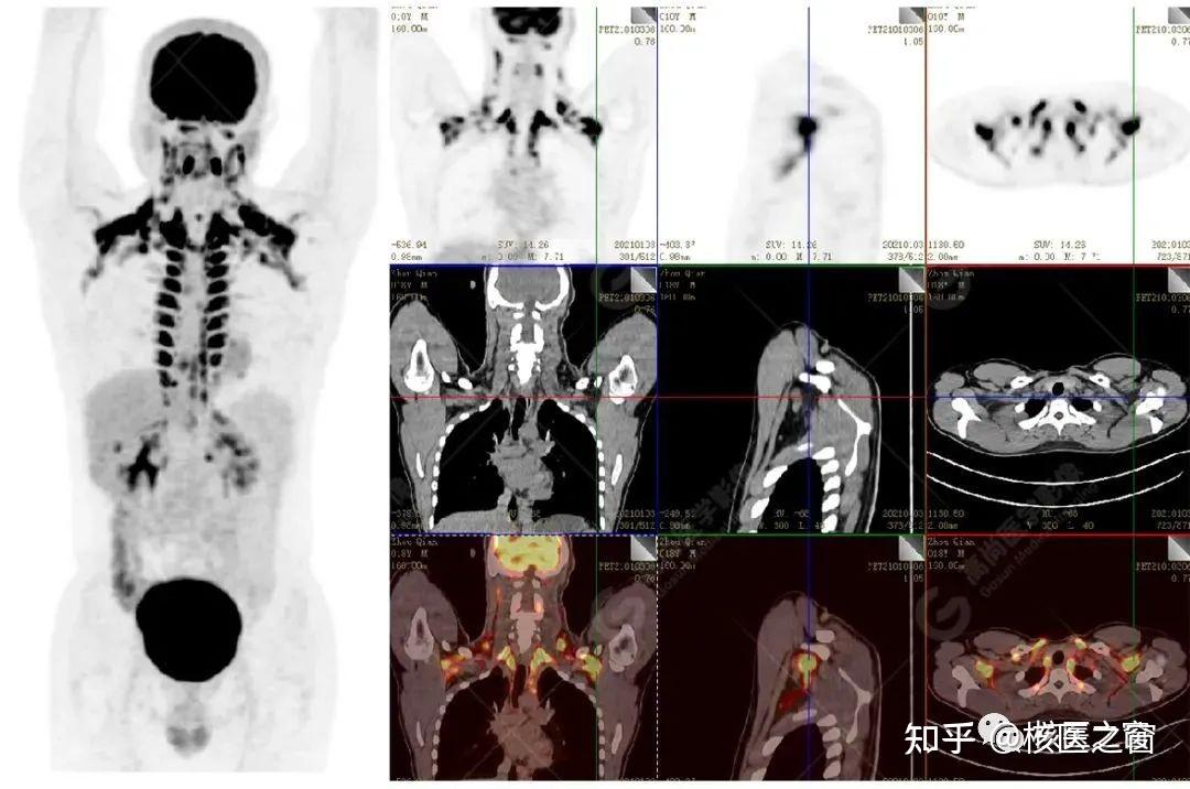 Pet ct 