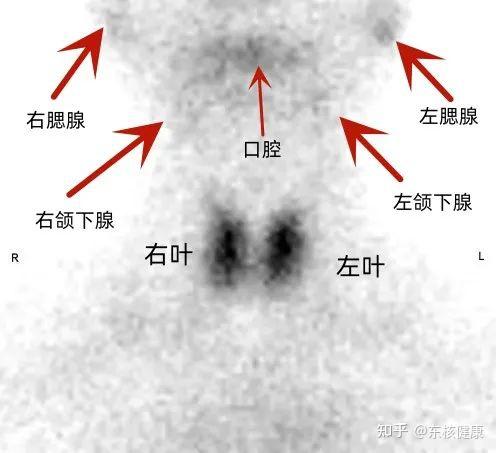 碘131全身显像正常图图片